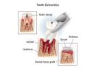 Quick & Comfortable Dental Extractions at The Smile Spa