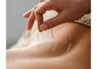 Acupuncture Treatment in Thornhill: Holistic Healing for Pain Relief