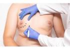 Gynecomastia and Liposuction Surgery: Do You Need Both?
