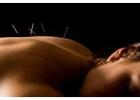 Pain Management Acupuncture in NYC | Back, Neck & Sciatica Relief