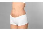 What Is the Cost of Liposuction Surgery?
