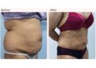 Latest Liposuction Technologies Used by Leading Surgeons