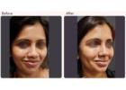 Dimple Creation Surgery Cost in Delhi - Dr Rajat Gupta