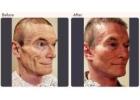 Facelift Surgery Cost In Delhi NCR - Dr Rajat Gupta