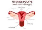 Hysteroscopy Procedure in Delhi - Dr Rhythm Gupta