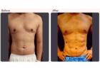 Six Pack Abs Surgery in Delhi - Dr Rajat Gupta