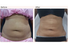 Liposuction Surgery Cost in Delhi - Dr Rajat Gupta