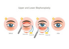 Eyelid surgery cost in Delhi - Dr Rajat Gupta