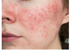 Targeted and Effective Face Spot Treatment – Clearer Skin Starts Here