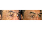 Expert Guide on How to Remove a Skin Tag from Eyelid Safely and Effectively