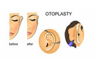 Ear Reshaping Surgery in Delhi - Dr Rajat Gupta