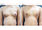 Gynecomastia Surgery Cost in Delhi - Dr Rajat Gupta
