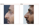 Rhinoplasty Surgery in Delhi - Dr Rajat Gupta