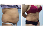 Breast reconstruction surgery in Delhi - Dr Rajat Gupta