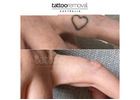 Tattoo Removal Brisbane | Safe & Professional Laser Tattoo Removal