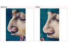 Nose surgery cost in Delhi - Dr Rajat Gupta