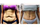 Tummy Tuck Surgery cost in Delhi - Dr Rajat Gupta