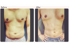 Liposuction Surgeon in Delhi - Dr Rajat Gupta