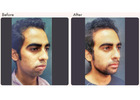 Chin Augmentation in Delhi - Dr Rajat Gupta