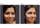 Dimple Creation Surgery in Delhi - Dr Rajat Gupta