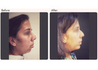 Chin Augmentation in Delhi - Dr Rajat Gupta