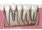 Emergency Dentistry in Abbotsford | Fast, Reliable Emergency Dental Care