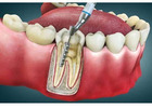 Root Canal Treatment in Abbotsford | Save Your Natural Tooth