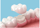 Dental Implants Cost in Abbotsford | Pricing & Treatment Guide