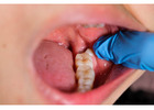 Wisdom Teeth Removal in Abbotsford | Safe & Comfortable Care