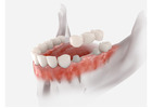 How Long Do Dental Crowns Last? | Abbotsford Dentist